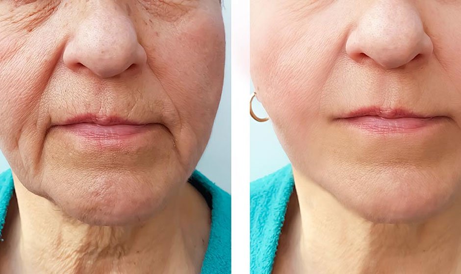 Marionette Lines and Botox: Effective Treatment Options for Youthful Skin