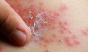 Understanding Adult Diaper Rash Symptoms Causes And Treatment JimJocoy